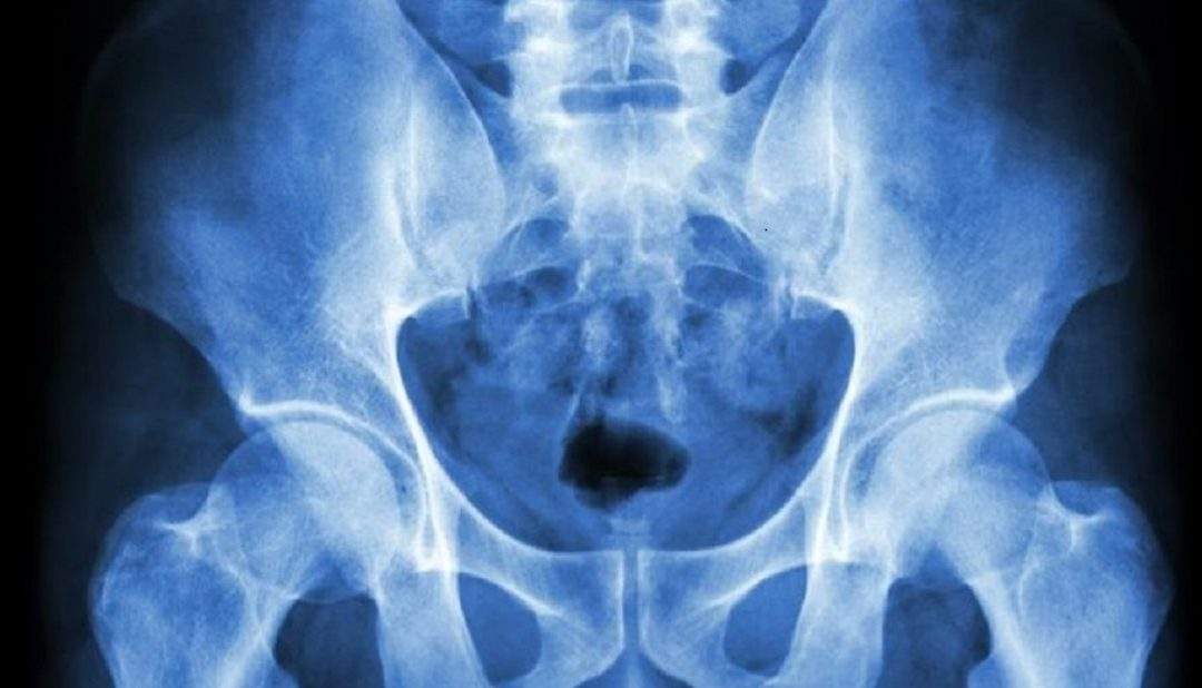 osteopatia de pubis