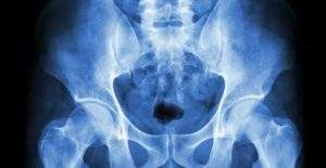 osteopatia de pubis