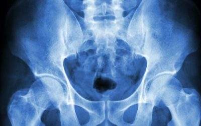Osteopatía del pubis