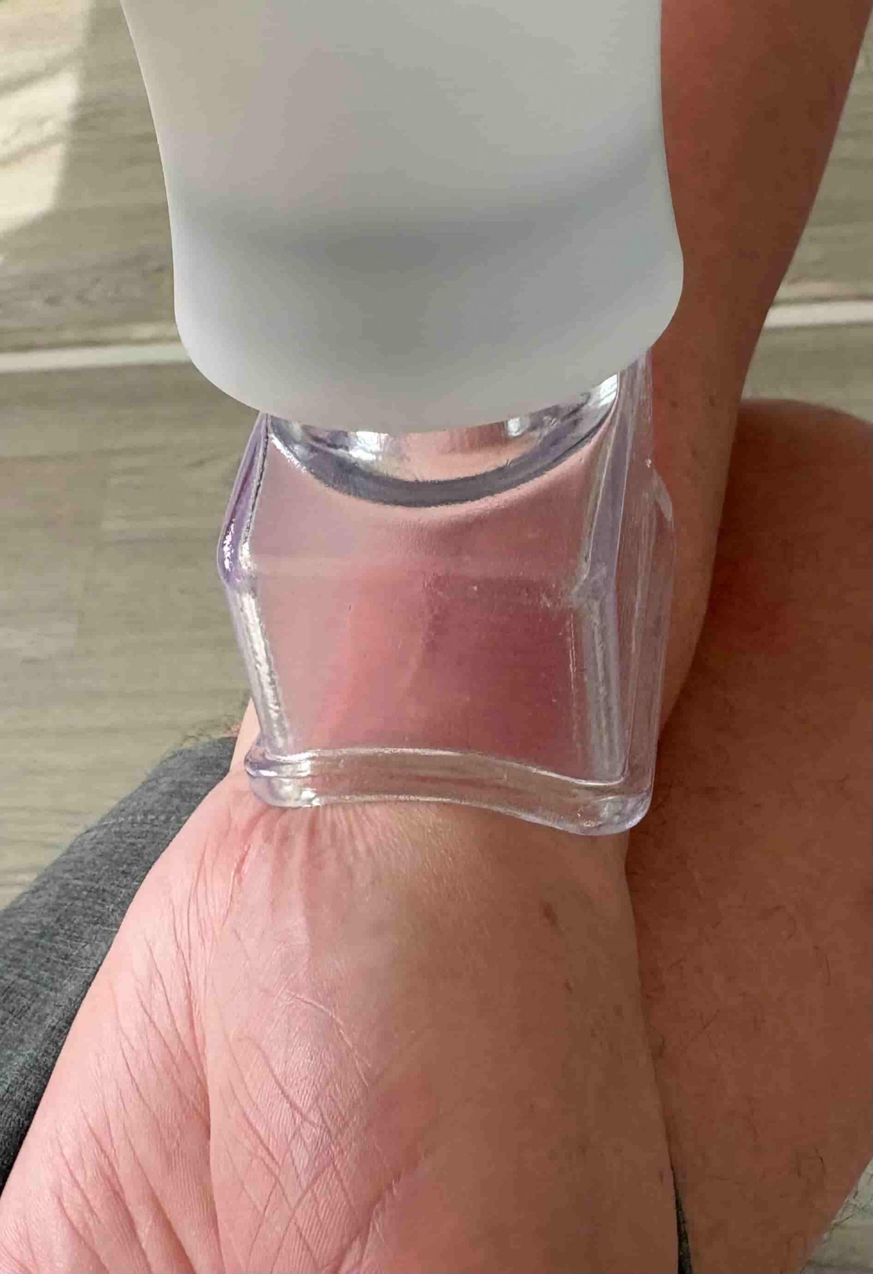 Descompresión muscular negativa con MD3 sobre la cicatriz de una fractura de muñeca en Sevilla