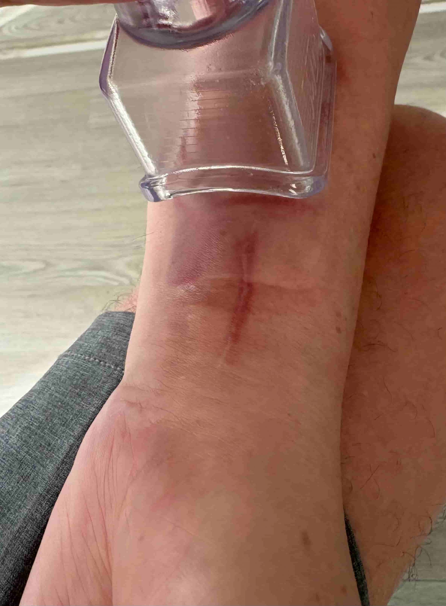 Trabajo de la cicatriz tras cirugía de muñeca con fisioterapia en Mairena del Aljarafe